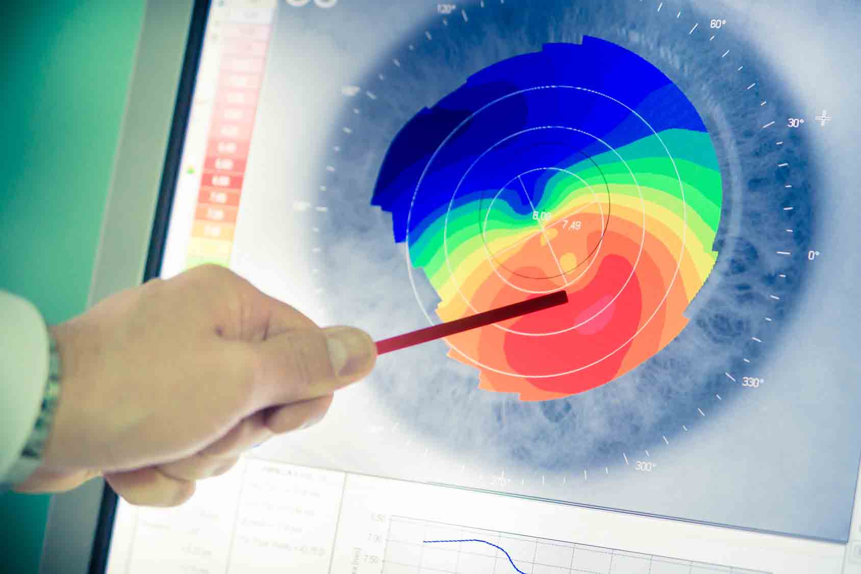 keratocone exavue materiel optique et optometrie opticien paris